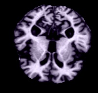 ModerateDemented (103).jpg