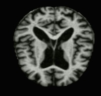 ModerateDemented (105).jpg