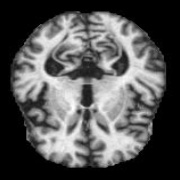 ModerateDemented (119).jpg