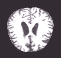 ModerateDemented (128).jpg