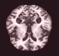 ModerateDemented (140).jpg